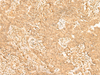 Immunohistochemistry of paraffin-embedded Human ovarian cancer tissue  using ST8SIA4 Polyclonal Antibody at dilution of 1:50(×200)