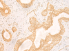 Immunohistochemistry of paraffin-embedded Human breast cancer tissue  using GSG1L Polyclonal Antibody at dilution of 1:50(×200)