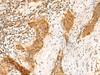 Immunohistochemistry of paraffin-embedded Human esophagus cancer tissue  using GINS2 Polyclonal Antibody at dilution of 1:50(×200)