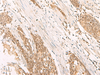 Immunohistochemistry of paraffin-embedded Human esophagus cancer tissue  using POP4 Polyclonal Antibody at dilution of 1:65(×200)