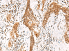 Immunohistochemistry of paraffin-embedded Human esophagus cancer tissue  using DGCR6L Polyclonal Antibody at dilution of 1:65(×200)