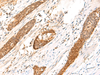 Immunohistochemistry of paraffin-embedded Human esophagus cancer tissue  using DCAF10 Polyclonal Antibody at dilution of 1:130(×200)