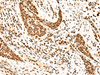 Immunohistochemistry of paraffin-embedded Human esophagus cancer tissue  using SNRPB2 Polyclonal Antibody at dilution of 1:75(×200)
