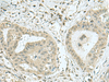 Immunohistochemistry of paraffin-embedded Human thyroid cancer tissue  using THTPA Polyclonal Antibody at dilution of 1:70(×200)