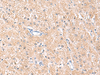 Immunohistochemistry of paraffin-embedded Human liver cancer tissue  using MLKL Polyclonal Antibody at dilution of 1:85(×200)