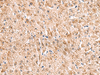 Immunohistochemistry of paraffin-embedded Human liver cancer tissue  using HCCS Polyclonal Antibody at dilution of 1:110(×200)