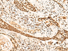 Immunohistochemistry of paraffin-embedded Human esophagus cancer tissue  using METTL1 Polyclonal Antibody at dilution of 1:50(×200)
