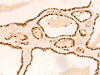 Immunohistochemistry of paraffin-embedded Human thyroid cancer tissue  using METTL1 Polyclonal Antibody at dilution of 1:50(×200)