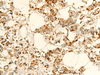 Immunohistochemistry of paraffin-embedded Human breast cancer tissue  using NAPRT Polyclonal Antibody at dilution of 1:50(×200)