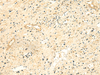 Immunohistochemistry of paraffin-embedded Human prost ate cancer tissue  using NTAN1 Polyclonal Antibody at dilution of 1:50(×200)
