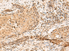 Immunohistochemistry of paraffin-embedded Human esophagus cancer tissue  using PTH1R Polyclonal Antibody at dilution of 1:65(×200)