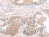 Immunohistochemistry of paraffin-embedded Human colorectal cancer tissue  using HMGCLL1 Polyclonal Antibody at dilution of 1:60(×200)
