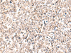 Immunohistochemistry of paraffin-embedded Human lung cancer tissue  using EWSR1 Polyclonal Antibody at dilution of 1:70(×200)