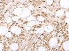 Immunohistochemistry of paraffin-embedded Human breast cancer tissue  using RBFOX2 Polyclonal Antibody at dilution of 1:80(×200)