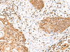 Immunohistochemistry of paraffin-embedded Human esophagus cancer tissue  using GMPPB Polyclonal Antibody at dilution of 1:50(×200)