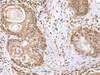 Immunohistochemistry of paraffin-embedded Human esophagus cancer tissue  using ELAC1 Polyclonal Antibody at dilution of 1:65(×200)