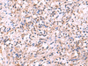 Immunohistochemistry of paraffin-embedded Human cervical cancer tissue  using LMCD1 Polyclonal Antibody at dilution of 1:100(×200)