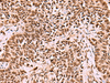 Immunohistochemistry of paraffin-embedded Human ovarian cancer tissue  using LDB1 Polyclonal Antibody at dilution of 1:70(×200)