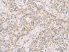 Immunohistochemistry of paraffin-embedded Human ovarian cancer tissue  using RNF13 Polyclonal Antibody at dilution of 1:60(×200)