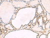 Immunohistochemistry of paraffin-embedded Human thyroid cancer tissue  using RNF13 Polyclonal Antibody at dilution of 1:60(×200)
