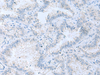 Immunohistochemistry of paraffin-embedded Human lung cancer tissue  using ATP6V1C1 Polyclonal Antibody at dilution of 1:100(×200)
