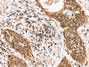 Immunohistochemistry of paraffin-embedded Human esophagus cancer tissue  using GABPB1 Polyclonal Antibody at dilution of 1:70(×200)