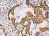 Immunohistochemistry of paraffin-embedded Human cervical cancer tissue  using PDHA1 Polyclonal Antibody at dilution of 1:50(×200)