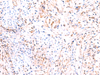 Immunohistochemistry of paraffin-embedded Human cervical cancer tissue  using PHKG2 Polyclonal Antibody at dilution of 1:60(×200)