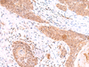 Immunohistochemistry of paraffin-embedded Human esophagus cancer tissue  using COPS3 Polyclonal Antibody at dilution of 1:60(×200)