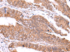 Immunohistochemistry of paraffin-embedded Human colorectal cancer tissue  using GATM Polyclonal Antibody at dilution of 1:70(×200)