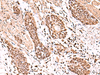 Immunohistochemistry of paraffin-embedded Human esophagus cancer tissue  using ACTL6B Polyclonal Antibody at dilution of 1:100(×200)