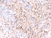 Immunohistochemistry of paraffin-embedded Human cervical cancer tissue  using MANSC1 Polyclonal Antibody at dilution of 1:105(×200)