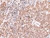 Immunohistochemistry of paraffin-embedded Human lung cancer tissue  using RCOR3 Polyclonal Antibody at dilution of 1:60(×200)