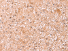 Immunohistochemistry of paraffin-embedded Human liver cancer tissue  using ASTN2 Polyclonal Antibody at dilution of 1:80(×200)