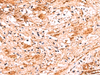 Immunohistochemistry of paraffin-embedded Human liver cancer tissue  using NADK Polyclonal Antibody at dilution of 1:70(×200)