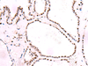 Immunohistochemistry of paraffin-embedded Human thyroid cancer tissue  using NASP Polyclonal Antibody at dilution of 1:55(×200)