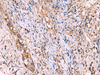Immunohistochemistry of paraffin-embedded Human cervical cancer tissue  using GALK2 Polyclonal Antibody at dilution of 1:95(×200)