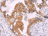 Immunohistochemistry of paraffin-embedded Human cervical cancer tissue  using FKBP4 Polyclonal Antibody at dilution of 1:65(×200)