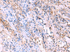 Immunohistochemistry of paraffin-embedded Human cervical cancer tissue  using FUCA2 Polyclonal Antibody at dilution of 1:70(×200)