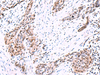 Immunohistochemistry of paraffin-embedded Human esophagus cancer tissue  using POLD2 Polyclonal Antibody at dilution of 1:95(×200)