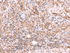 Immunohistochemistry of paraffin-embedded Human cervical cancer tissue  using TTC38 Polyclonal Antibody at dilution of 1:50(×200)