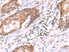 Immunohistochemistry of paraffin-embedded Human esophagus cancer tissue  using KATNAL1 Polyclonal Antibody at dilution of 1:95(×200)