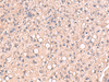 Immunohistochemistry of paraffin-embedded Human liver cancer tissue  using RIOK1 Polyclonal Antibody at dilution of 1:80(×200)