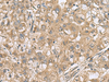 Immunohistochemistry of paraffin-embedded Human liver cancer tissue  using PAPSS2 Polyclonal Antibody at dilution of 1:60(×200)