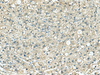 Immunohistochemistry of paraffin-embedded Human liver cancer tissue  using SORBS2 Polyclonal Antibody at dilution of 1:120(×200)