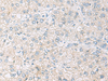 Immunohistochemistry of paraffin-embedded Human liver cancer tissue  using FARP2 Polyclonal Antibody at dilution of 1:70(×200)