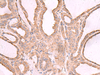 Immunohistochemistry of paraffin-embedded Human thyroid cancer tissue  using EEF1D Polyclonal Antibody at dilution of 1:65(×200)