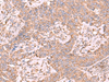 Immunohistochemistry of paraffin-embedded Human ovarian cancer tissue  using EEF1D Polyclonal Antibody at dilution of 1:65(×200)