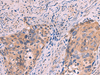 Immunohistochemistry of paraffin-embedded Human cervical cancer tissue  using PPEF1 Polyclonal Antibody at dilution of 1:100(×200)