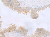 Immunohistochemistry of paraffin-embedded Human prost ate cancer tissue  using GPCPD1 Polyclonal Antibody at dilution of 1:55(×200)